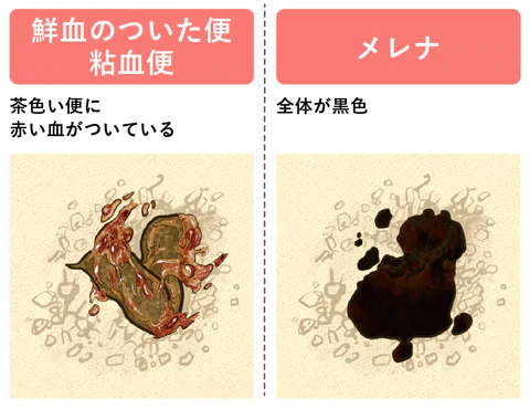 黒色便・メレナについて